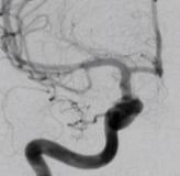 Angiografia digital após a cirurgia no cérebro e clipagem do aneurisma cerebral.