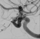 Angiografia digital após a cirurgia no cérebro e clipagem do aneurisma cerebral.