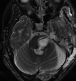 Ressonância corte axial após a cirurgia no cérebro e remoção total do cavernoma.