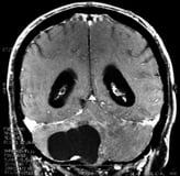 Ressonância de paciente com cefaleia e tumor no cerebelo antes da cirurgia.
