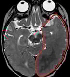 Ressonância de menino de 7 meses com extensa displasia cortical (em vermelho) e epilepsia.