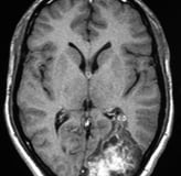 Ressonância de paciente epiléptico com grande tumor occipital esquerdo antes da cirurgia no cérebro.