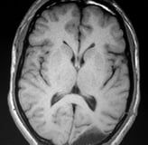 Ressonância magnética após a cirurgia com remoção total do tumor e paciente livre de epilepsia.