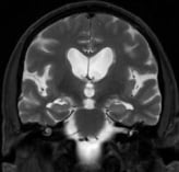 Ressonância coronal do mesmo homem com hidrocefalia e dificuldade para andar.