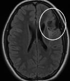 Ressonância de menino de 16 anos com epilepsia desde os 13, com sequela de isquemia frontal esquerda