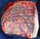 Imagem intraoperatória com uso de placa subdural.