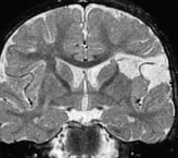 Ressonância após a cirurgia no cérebro com remoção total da displasia. Ele ficou livre de epilepsia.