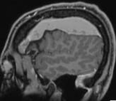 Ressonância de homem de 50 anos com volumoso hematoma subdural crônico fronto-parietal direito.
