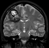 Cefaleia intensa e grande sangramento intracerebral antes da cirurgia no cérebro.