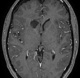 Ressonância após a cirurgia com remoção total do cavernoma e paciente livre de epilepsia.epsia.