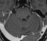 Ressonância após a cirurgia com remoção do cavernoma e sem risco de novo sangramento.