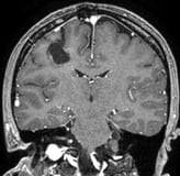 Ressonância após a cirurgia com a remoção total do cavernoma.
