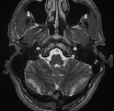 Ressonâcia magnética após a cirurgia com remoção total do tumor.