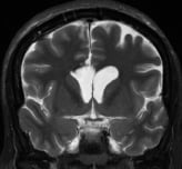 Ressonância após a cirurgia no cérebro com remoção do cisto colóide e resolução da hidrocefalia.