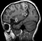 Ressonância após a cirurgia no cérebro e desconexão da displasia cortical.