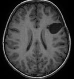 Ressonância após a cirurgia do cérebro com remoção total da displasia. Ele se curou da epilepsia.