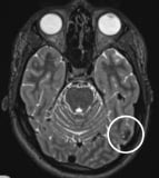 Ressonância de homem de 23 anos com crises epilépticas desde os 12 anos com tumor cerebral.