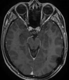 Ressonância após a cirurgia no cérebro com a remoção total do tumor e sem crises.