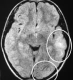 Ressonância de menina de 10 anos com epilepsia desde os 2 anos de idade com túberes (cíuculos).