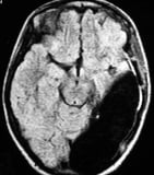 Ressonância após a cirurgia no cérebro e remoção total dos túberes. Ela se curou da epilepsia.