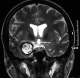 Ressonância de paciente com sangramento intracerebral e cavernoma antes da cirurgia no cérebro.