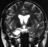 Ressonância após a cirurgia com remoção total do cavernoma temporal medial.