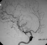Angiografia carotídea projeção oblíqua após a cirurgia no cérebro e a retirada da MAV.