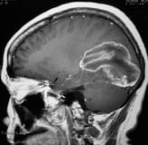 Ressonância de paciente com câncer de mama e volumoso tumor occipital antes da cirurgia no cérebro.