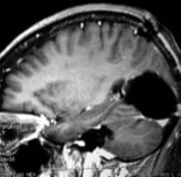 Ressonância após a cirurgia com remoção total do tumor.