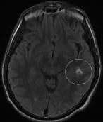 Paciente com epilepsia e cavernoma antes da cirurgia no cérebro.