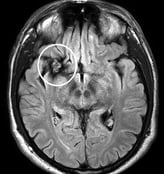 Paciente epiléptico com cavernoma antes da cirurgia no cérebro.