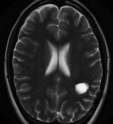 Ressonância após a cirurgia com remoção total do cavernoma.