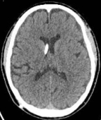 Tomografia após a cirurgia no cérebro (derivação) com melhora dos sintomas.