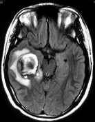 Paciente com cefaleia e sangramento intracerebral devido a cavernoma., antes da cirurgia no cérebro.