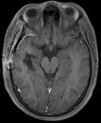 Ressonância após a cirurgia com remoção total do cavernoma. e paciente livre de novos sangramentos.