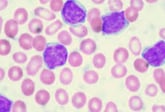 والعلاج والشفاء leukemia لبوكيميا