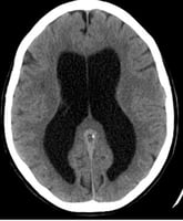 Hydrocephalus