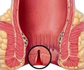 Fissures in Anus