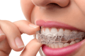 ortodoncia invisible con alineadores dentales