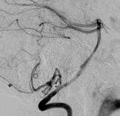 Angiografia digital projeção perfil após a cirurgia no cérebro e clipagem do aneurisma cerebral.