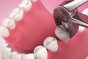 a dental model with extraction of a tooth