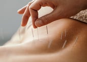 Acupuncture