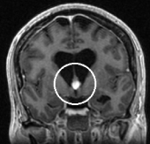 Ressonância coronal da mesma mulher com cisto coóide e hidrocefalia obstrutiva.