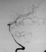Angiografia vértebro-basilar após a cirurgia no cérebro e remoção da MAV.