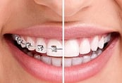 before and after view of a woman with braces 