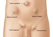 Fotos de hérnias, procedimentos cirúrgicos realizados pelo Dr. Humberto Forte Cirurgião Pediátrico