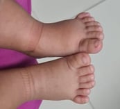 Foto malformações, procedimento cirúrgico realizado pelo Dr. Humberto Forte Cirurgião Pediátrico