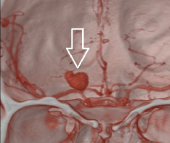 Angiotomografia 3D projeção frontal mostrando um volumoso aneurisma cerebral (seta).