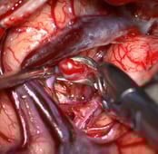 Clipagem de um aneurisma da artéria cerebral média com clipe de titânio.