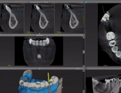 Implant Surgical guide design